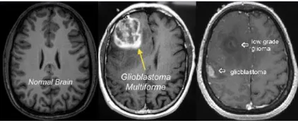 Figure 1. MRI Brain Image comparing normal and Glioblastoma and Benign Tumors 