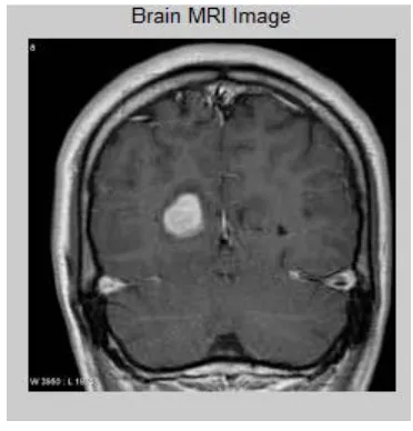 Figure 4. Input Benign MRI brain image 