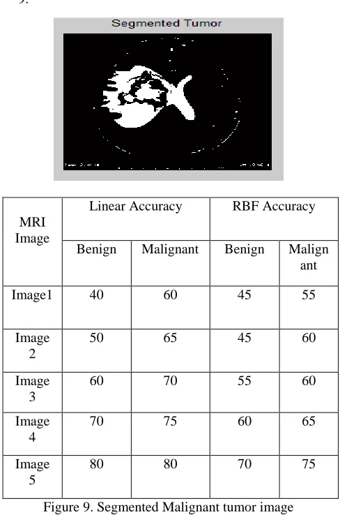Figure 9. Segmented Malignant tumor image 