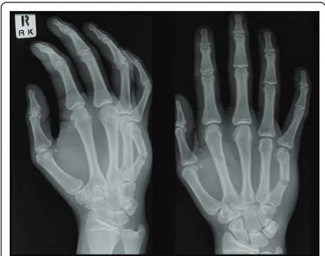 Figure 1 Radiograph of a 16 year old male patient withdisplaced little finger metacarpal neck fracture.