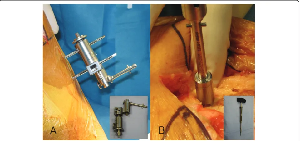 Figure 1 Two 3 mm Apex pins (A) were positioned in the proximal tibia 10 cm below the tibial joint and a single anti-rotation pin (B)was placed off center in the metaphysis approximately 4 cm above the trochlear articular surface.