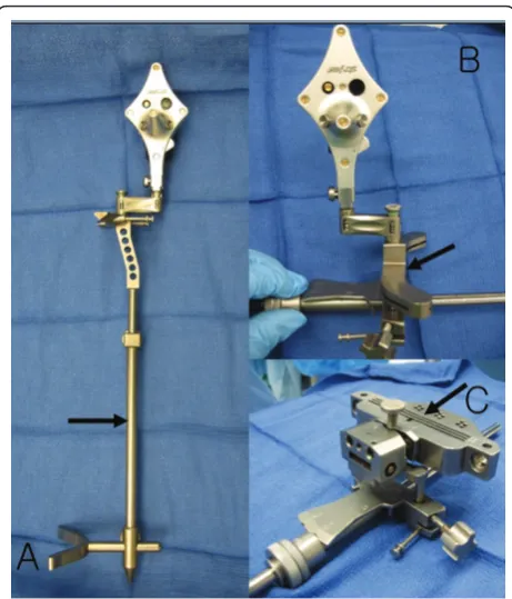 Figure 3 Navigation enhanced femoral rotation cutting guide (arrow) and a navigation enhanced conventional distal alignment guidewith a distal femoral resection pivotal cutting block (arrowhead) were attached to the conventional distal alignment guide as shown (A,B).