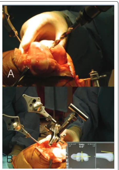 Figure 6 A “starting” hole was created in the distal femur forIM rod insertion (A). The femoral component rotational axis wascontrolled under navigation guidance using a tracker connected tothe anterior femoral cutting jig (B).