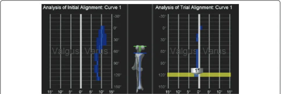 Figure 8 After trial reduction, tibio-femoral mechanical alignment was recorded and compared with preoperative tibio-femoralmechanical alignment.