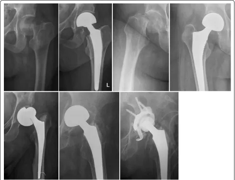 Figure 2 Femoral neck fracture treated with bipolar hemiarthroplasty. Cemented (upper left panel) and press fit technique (upper rightpanel)