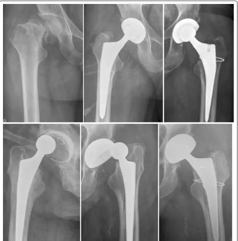 Figure 3 Femoral neck fracture treated with total hip arthroplasty (upper left panel)