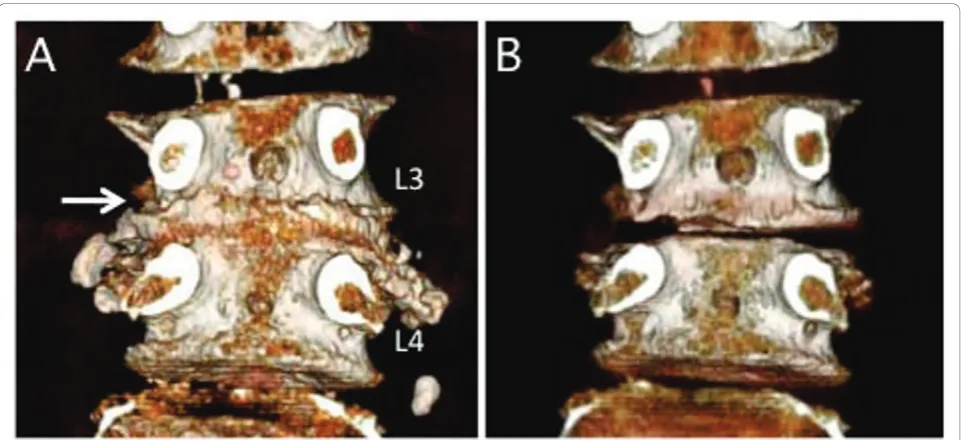 Figure 3 Case 2. A three-dementional CT-discogram obtained from a 69-year-old female who presented severe left leg pain
