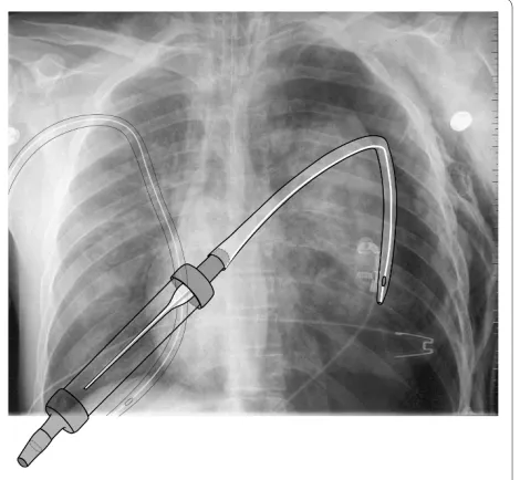 Figure 2 Chest film with the graphical representation of the chest tube within pleural cavity and the correctly connected flutter valve.