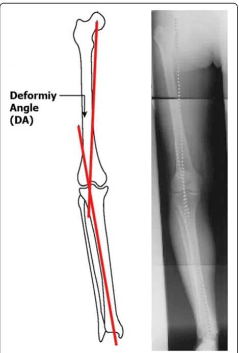 Figure 2 Deformity angle (DA) measurement.