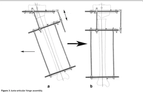 Figure 3 Juxta-articular hinge assembly.