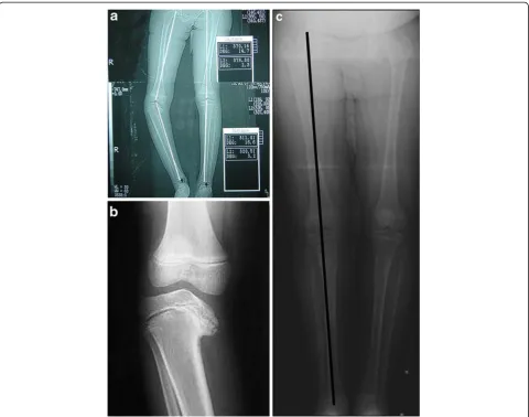 Figure 4 (a) Preoperative A-P radiogram of a 12-year-old female with right sided late onset tibia vara with a preoperative DA angle of−45°