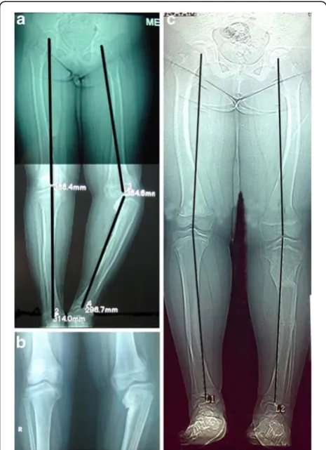Figure 5 (a) Preoperative A-P radiogram of a 9 year old maleshows left knee stage VI of the Langenskiold staging