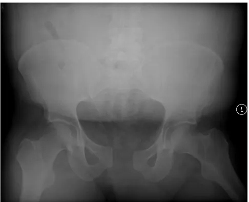 Figure 1complete disruption of the right sacroiliac jointinferior rami fractures, symphyseal diastasis of 4 cm and book pelvic fracture with right, nondisplaced superior and Presenting AP pelvis radiograph demonstrating the open-Presenting AP pelvis radiograph demonstrating the open-book pelvic fracture with right, nondisplaced superior and inferior rami fractures, symphyseal dia-stasis of 4 cm and complete disruption of the right sacroiliac joint.