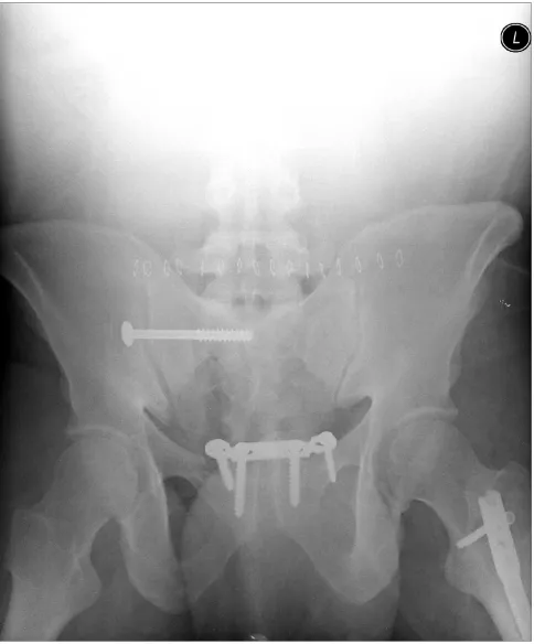Figure 5tory symphyseal and sacroiliac joint reduction and fixationImmediate postoperative outlet radiograph showing satisfac-Immediate postoperative outlet radiograph showing satisfactory symphyseal and sacroiliac joint reduction and fixation.
