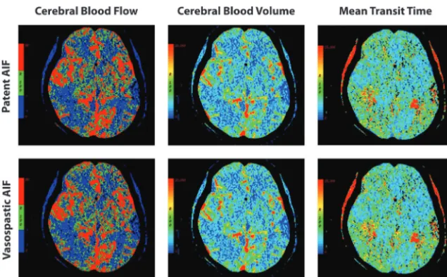 FIG 3. Functional maps of CBF, CBV, and MTT using an AIFVSP and AIFnon-VSP within the samepatient