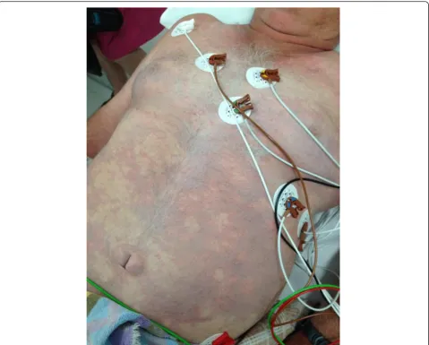 Fig. 4 Cutis marmorata. This picture (not belonging to patient D) shows extensive cutis marmorata, a symptom of decompression illness