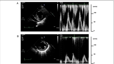Fig. 3 Simultaneous right and left ventricular measurements showed elevated and approximately equal end-diastolic pressures with dip and plateaupattern (a)