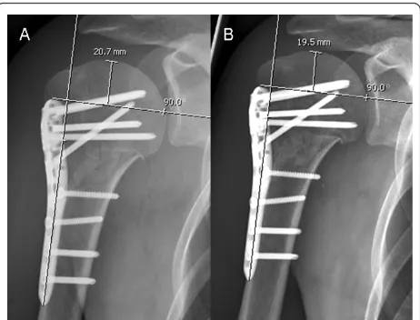 Figure 4 Example of a patient in group C- (no calcar screw)with a loss of reduction of 1.2 mm when comparingpostoperative (A) and follow-up radiographs at 3 months (B).