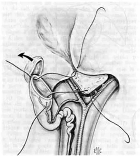 Figure 5operation for biliary atresia between 1968 and 1983 at Bicê-biliary atresia: a study of 63 patients who survived for over 20 years with their native liver