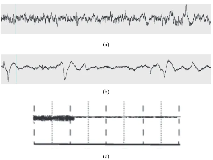 Fig. 9. In REM sleep, (a) EEG (alpha) (b) rapid eye movement (c) EMG amplitude tone. 