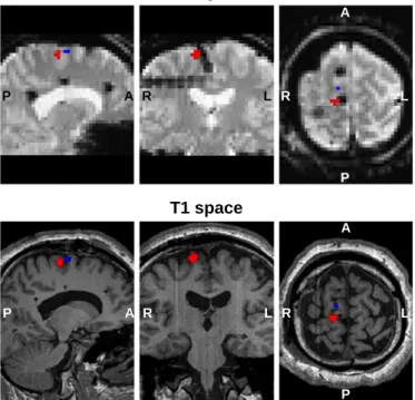 Fig. 4. Representative example (patient ID: B, events of interest set: S 2 , see Table 1) of IED onset and width related BOLD changes (p b 0.05, uncorrected), within a 10 mm radius sphere centred at middle distance between the pair of icEEG contacts that s