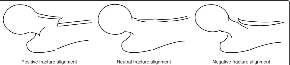 Fig. 1 Classification of fracture alignments on the lateral view [11, 12]. Positive alignment, with the anteriorly displaced proximal fragment; neutralalignment, with continuous alignment between the proximal fragment and distal fragment; and negative alignment, with the posteriorly displacedproximal fragment are shown