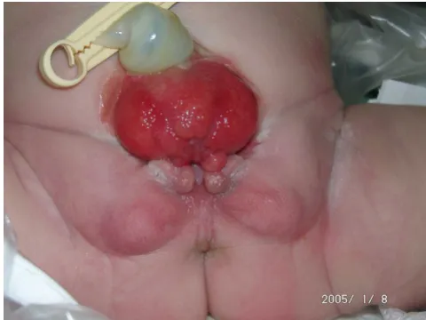 Figure 2Female baby with classical bladder exstrophyFemale baby with classical bladder exstrophy.