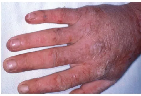 Figure 2Acute photosensitivity reaction in EPPAcute photosensitivity reaction in EPP.