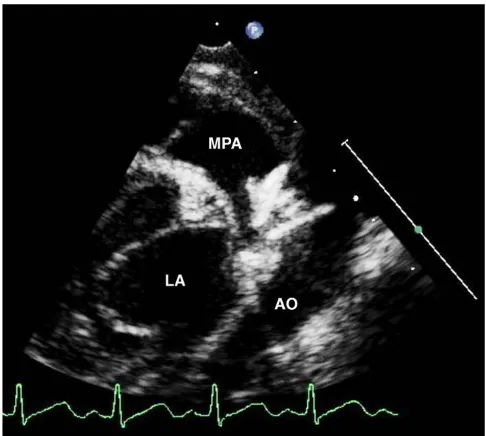 Figure 5Amplatzer ductal occluder II™Echocardiogram following closure of patent duct with an Echocardiogram following closure of patent duct with an Amplatzer ductal occluder II™