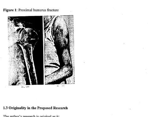 Figure 1: Proximal humerus fracture