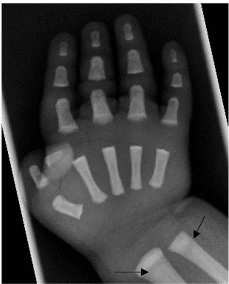 Figure 6Severe ARO: Right hand radiograph, age 2 weeksSevere ARO: Right hand radiograph, age 2 weeks