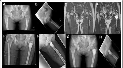 Fig. 1 Case presentation representing a 37-year-old female with fibrous dysplasia of the left proximal femur.radiographs showing fibrous dysplasia of left proximal femur.change