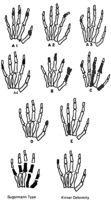 Table 2: Genomics of isolated brachydactyly