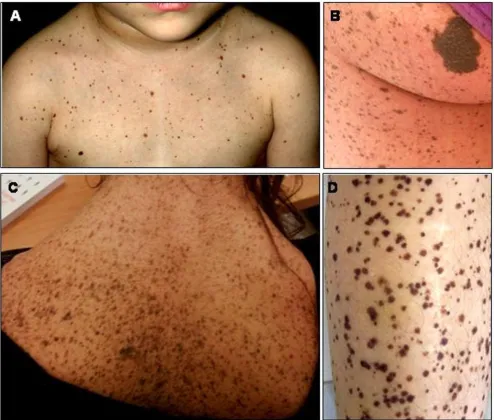 Figure 2Skin features of LS individual at different agesSkin features of LS individual at different ages