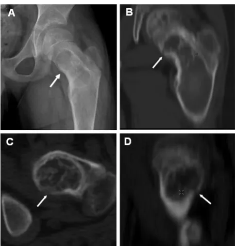 Figure 8CT for detecting subtle fracturesCT for detecting subtle fractures. A) This radiograph was from a 9-year-old boy who complained of new-onset, focal pain in the groin