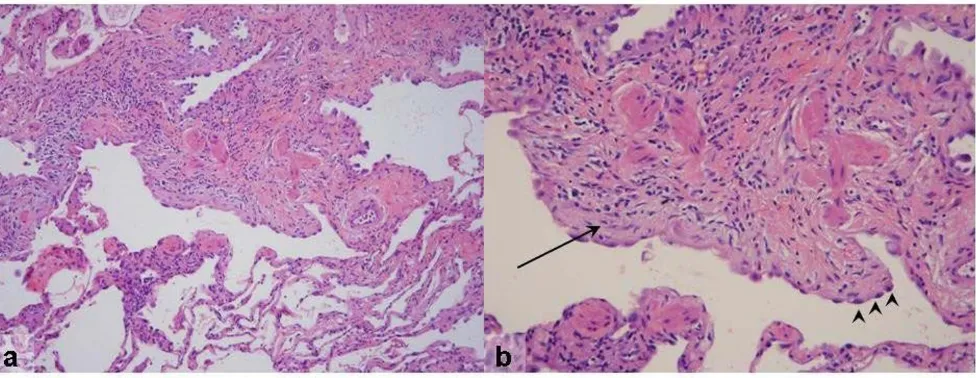Figure 4a) Low-magnification photomicrograph of UIP showing the characteristic heterogeneous involvement of the parenchymaFibrosis