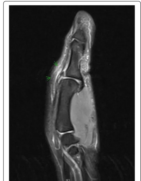 Figure 6 MRI of an old avulsion fracture of the UCL insertion.