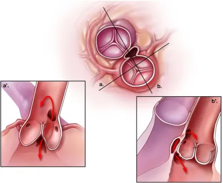 Figure 1Schematic representation of the most common type of aorto-left ventricular tunnelSchematic representation of the most common type of aorto-left ventricular tunnel