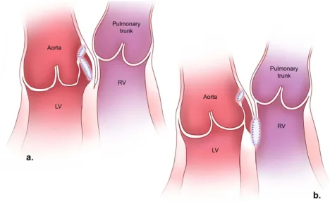 Figure 2Surgical repair of aorto-left ventricular tunnel (a) and aorto-right ventricular tunnel (b)is approached through the right ventricle or pulmonary valve, and the second patch lies completely separate from that in the closed with a patch inserted thr