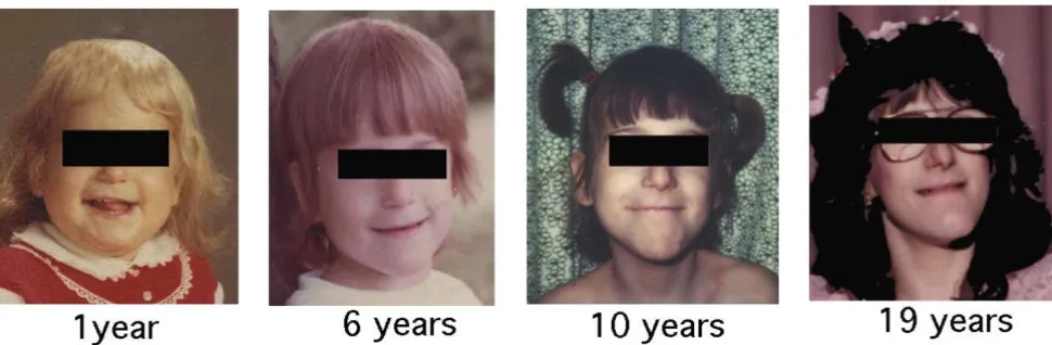 Figure 2Facial featuresFacial features. Facial features of a patient with HSAN over time