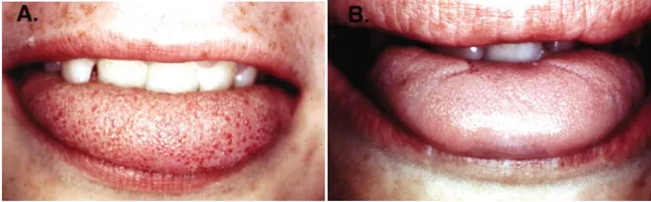 Figure 4A. Normal tongue with fungiform papillae present on the tipA. Normal tongue with fungiform papillae present on the tip