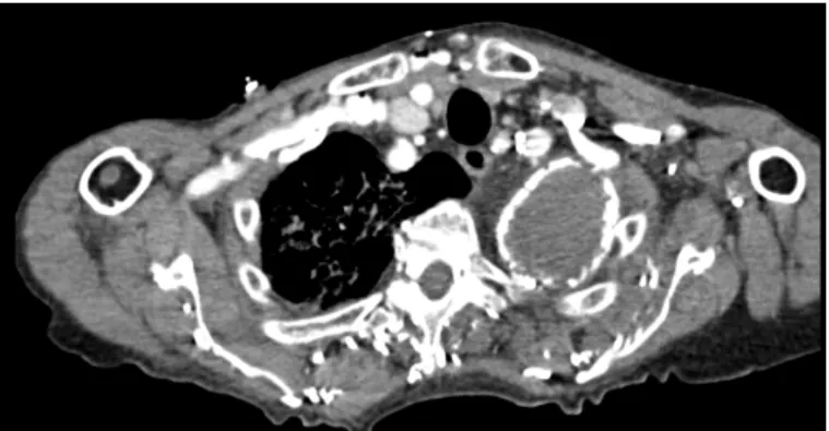 Fig. 3. A slide of CT scan showing aortic aneurysm disease