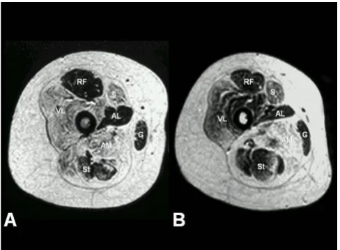 Figure 1disease (CCD) and multi-minicore disease (MmD)Selective muscle involvement in RYR1-related central core Selective muscle involvement in RYR1-related central core disease (CCD) and multi-minicore disease (MmD)