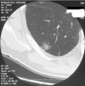 Fig. 1.4 A part solid nodule in the lower right lobe. This is a non-small-cell lung cancer.