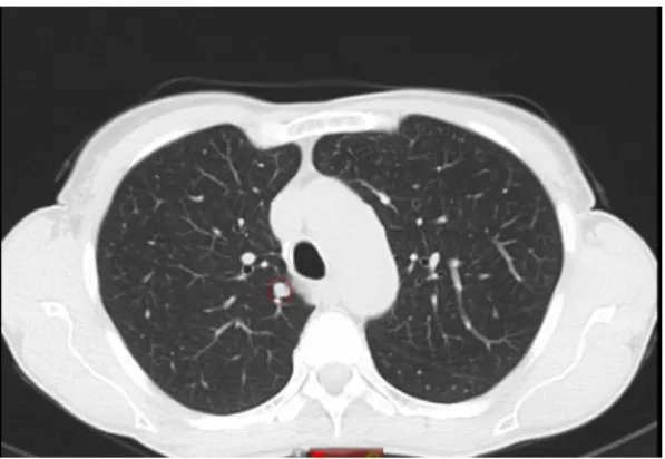 Fig. 2.4 Screenshot of the Osirix plugin with underlined a CAD mark in the circle. The radiologist can scroll through the slices and reject or accept the CAD mark