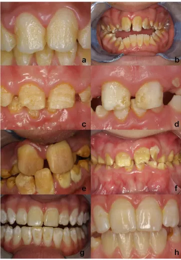 Figure 1Phenotypic descriptions of amelogenesis imperfectaPhenotypic descriptions of amelogenesis imperfecta