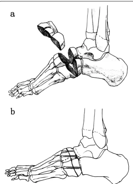 Figure 3 Postoperative X-ray. (a) The adjacent joint sparinginternal fixation between the Lisfranc line and the Cyma line (arrow)is shown