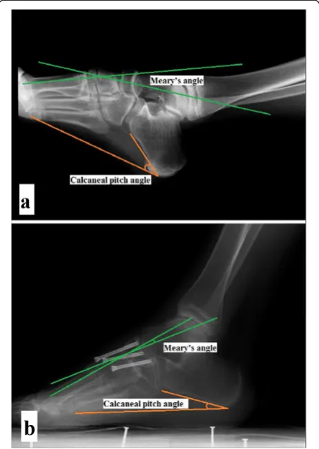 Figure 4 A severe deformity case achieved good correction.A lateral X-ray of a foot (a) shows the preoperative deformity, and(b) a postoperative X-ray of the same patient after midfoot osteotomyand adjacent joint sparing internal fixation is shown.
