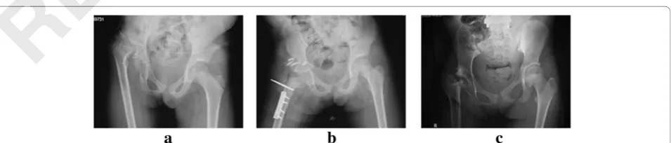 Figure 1 Serial radiographs of a 6-year-old boy who presented with tuberculosis of left hip dislocation
