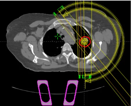 Figure 2. A transversal view of RapidArc plan setup in the Eclipse treatment planning system for lung cancer using double partial-arc technique